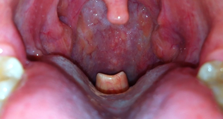 epiglot